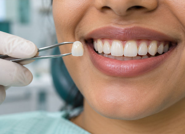 Ceramic Crowns