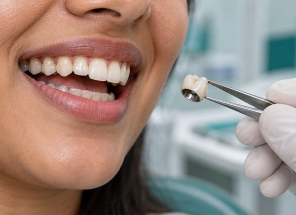Metal Crowns