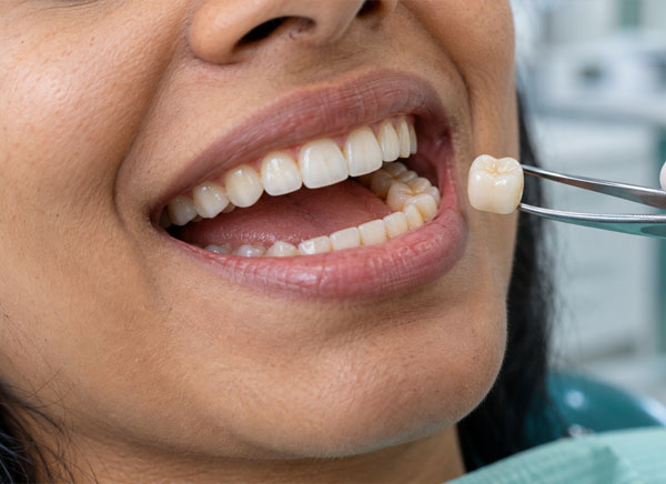 Zirconia Crowns