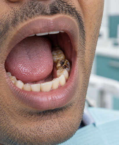 Bad Tooth