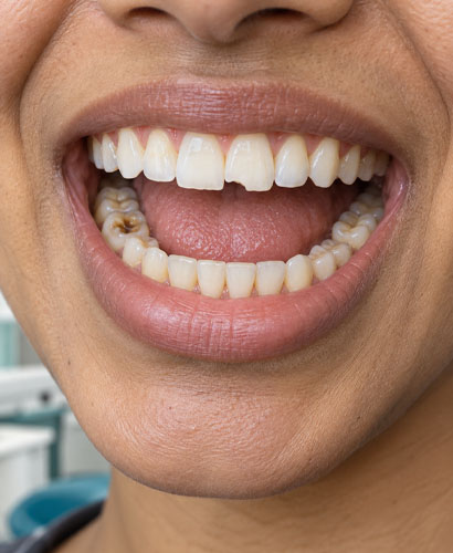 Chipped Teeth