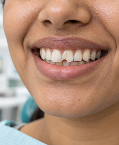 Crack Tooth