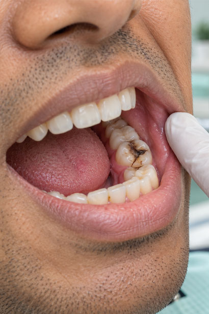 Cracked Tooth