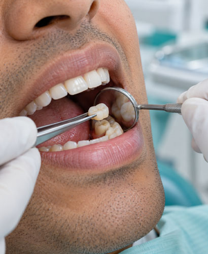 Dental Crown Treatment