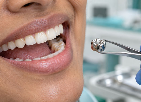 Metal crowns