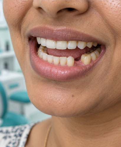 missing Tooth
