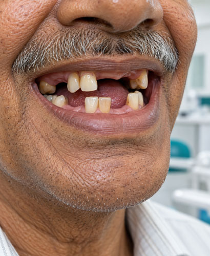 Missing Teeth