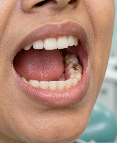 Root Canal
