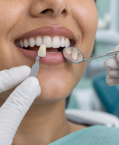 Smile Makeover
