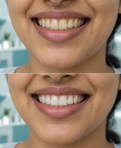 White Teeth