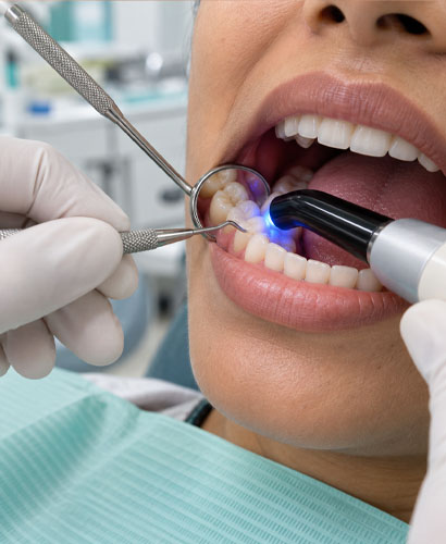 Teeth Color Filling