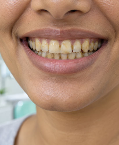 Yellow Teeth